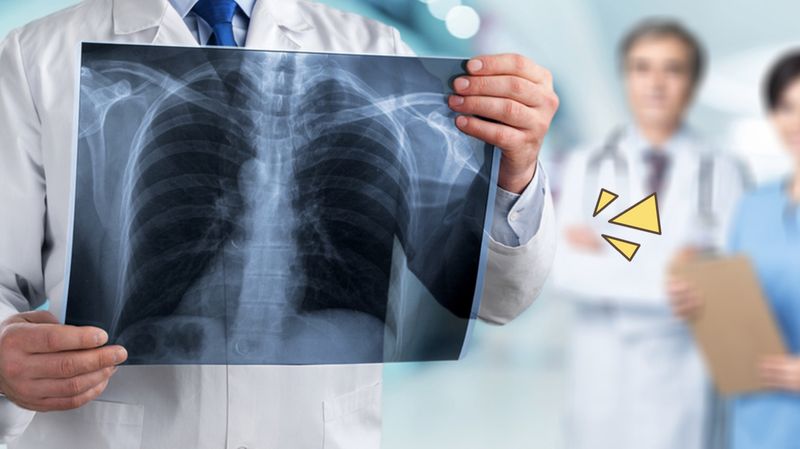 Foto ilustrasi Paru-Paru Menghitam akibat paparan asap rokok